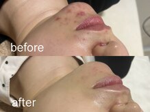 エムフロート(M float)/ハーブピーリング｜ニキビ