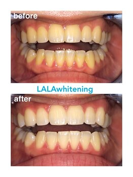 ララホワイトニング/Before&After強力ホワイトニング