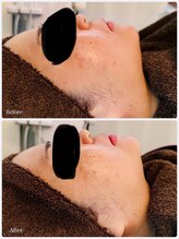 ビジュープラス 筑西下館店(Bijou+)/【40代お悩み】たるみ／1回直後