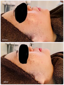 ビジュープラス 筑西下館店(Bijou+)/【40代お悩み】たるみ/1回直後