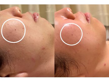 アンリミット 渋谷宮益坂店(Une limit)/【揺らぎ肌改善】