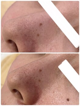 イル 名取店(iru)/毛穴洗浄フェイシャル