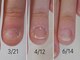 ネイルエニー(Nail Any)の写真/3か月で変化を実感◎深爪・自爪育成コース