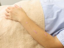 きよみ治療院/頭皮鍼と全身への鍼