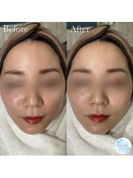 リノン/IPL光フェイシャルBefore/After