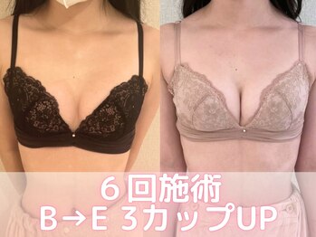 ヒヨコ 池袋西口店(Hiyoko)/バストアップ/育乳(16回施術)