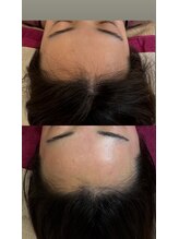 ジュエルオーキッド(Jewel orchids)/wax脱毛