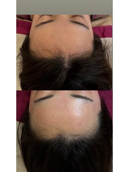 ジュエルオーキッド(Jewel orchids)/wax脱毛