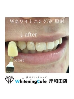 ホワイトニングカフェ 岸和田店(WhiteningCafe)/Wホワイトニング4回照射