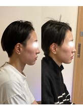 小顔22 ボルティ 本店(Bolty)/30代女性/中顔面矯正/13回目