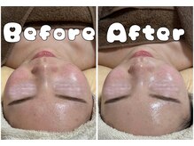 グラシア 倉敷店(Gracia)/ハーブピーリング＋毛穴洗浄