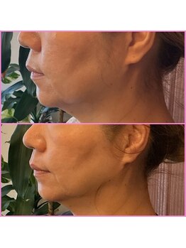 筋膜リリース整体院 喜楽/REDショット２回目