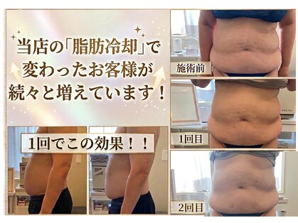 アイスリム バイ エメリス(Ice slim by Emeris)の写真