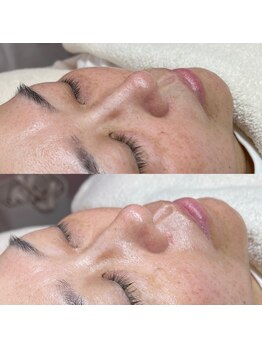 ホワイトワックス 浜松(WHITE WAX)/ワックスでお肌のクレンジング