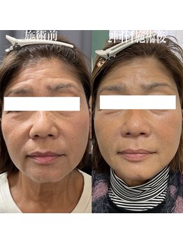 コリー(Kolly)/リフェイス"全顔"