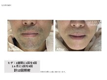 ラッシュ(RUSH)/たった4ヵ月でヒゲ剃りいらずに