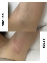 ワンダー(Wonder)/シュガーリング/脇