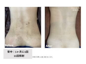 ラレピア(LA LEPIA)/お客様BeforeAfter☆