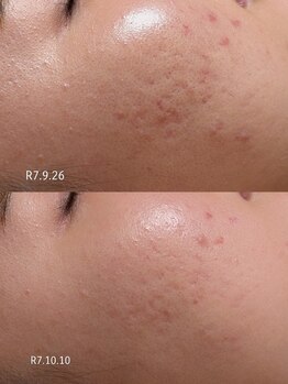 ビアンカーラ(Biancara)/【韓国式ハーブピーリング】