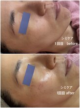 リエル(Liel)/シミケア★細かいシミもOK！