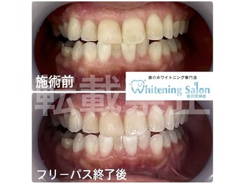 ホワイトニングサロン 福岡天神店/ホワイトニング