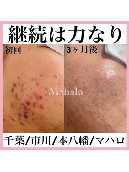 マハロ(Mahalo)/ニキビケア／肌質改善
