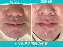 ミスターアンクール 鹿児島(Mr.uncoeur)/ヒゲ脱毛2回後