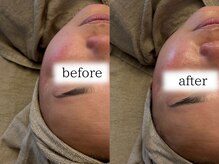 ベル(Belle)/ニードルピーリング1