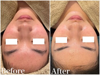 サロンドフェイス(Salon de Faith)/ハーブピーリング