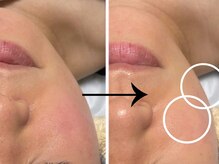 アウラ(AURA)/光フェイシャルでお肌元気に♪