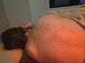 ムラサキ鍼灸治療院(MURASAKI鍼灸治療院)/帯状疱疹にも鍼灸