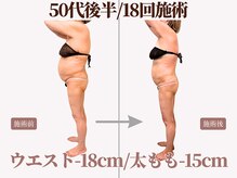 インディバや脂肪冷却やハイパーナイフ超えの圧倒的効果で痩身☆
