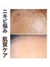 もう悩まない!!ニキビでお困りの人【肌質改善ケア】丁寧なカウセリングから