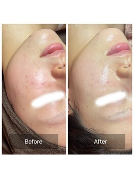 ヒール(heal)/水エステ