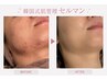 繰り返しニキビでお悩みの方【韓国式肌質管理セルマン】デコルテ・ヘッド付き