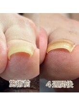 エンズネイル(Enn's nail)/巻き爪矯正