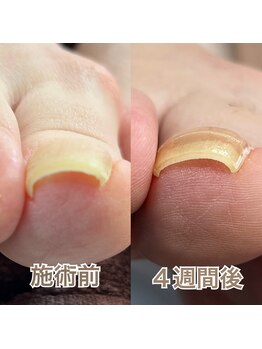 エンズネイル(Enn's nail)/巻き爪矯正