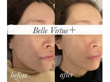 ベルバーチュプラス(Belle Virtue +)/カーボキシー