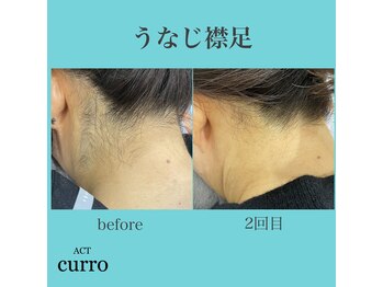 アクト クロ(ACT curro)/【うなじ襟足】脱毛施術例