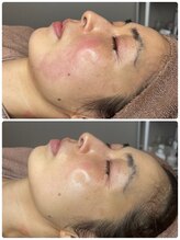 ララ(LALA)/韓国美容で人気のララピール導入