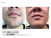 ラッシュ(RUSH)/9ヶ月でヒゲ脱毛完了！