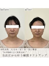 ヴェルシック(Belchic)/たるみとむくみまとめて改善