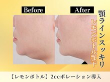 ポーベルポー(Peau Belle poe)の雰囲気（韓国小顔美容☆脂肪分解【レモンボトル】2cc導入でもっと小顔♪）