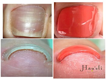 ハウオリ(Hau'oli)の写真/気になる爪の食い込みに…ジェルで行う巻き爪ケア☆１回目でも巻き爪が広がり楽になったと大満足の声多数◎