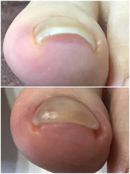 モアクリスタル(More Crystal)/巻き爪補正