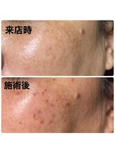 リーストア(Re:Store)/シミケア