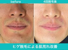 ミスターアンクール 鹿児島(Mr.uncoeur)/ヒゲ脱毛による肌荒れ改善