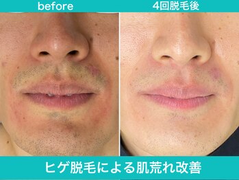 ミスターアンクール 鹿児島(Mr.uncoeur)/ヒゲ脱毛による肌荒れ改善