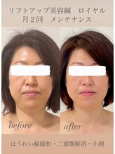 めい鍼灸院/リフトアップ美容鍼
