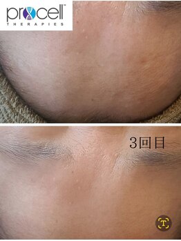 温(on)/プロセルセラピーズ肌質改善